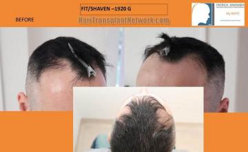 Hair transplantation surgery before and after pictures