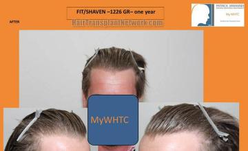 Hair restoration surgery before and after photos