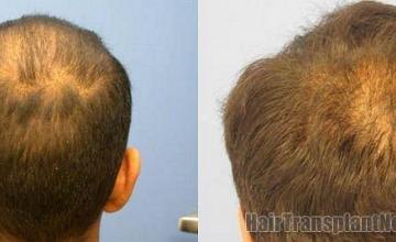 Back photos from 4200 graft hair replacement surgery