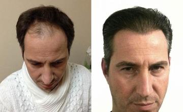 Front view - Before and after hair transplant surgery result images