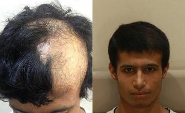 Hair transplantation surgery before and after images