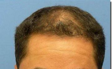 Hair restoration procedure results