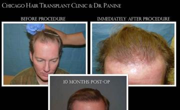 Hair restoration procedure before and after results