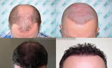 Hair restoration procedure before and after results