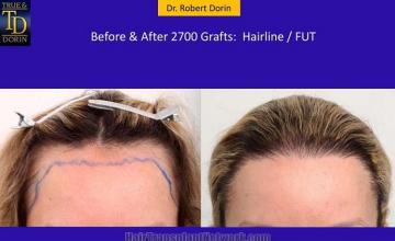 Hair transplantation surgery before and after photos