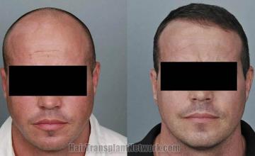 Hair restoration procedure before and after results