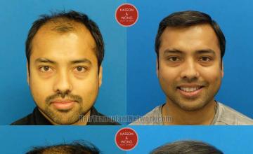 Hair restoration procedure before and after results