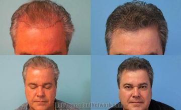 Hair transplantation surgery before and after photos