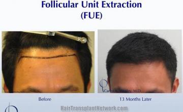 Hair restoration procedure before and after pictures