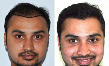 Before and after hair transplant procedure images