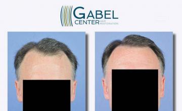 Hair restoration procedure before and after results