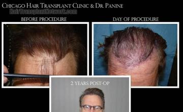 Hair transplantation surgery before and after pictures