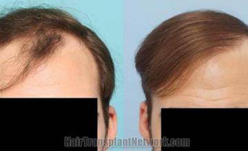 Hair restoration procedure before and after results