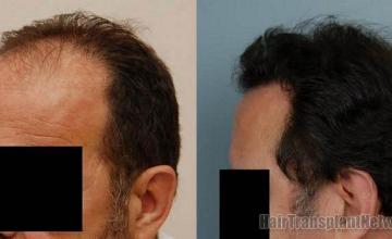 Hair restoration picctures showing left side before and after