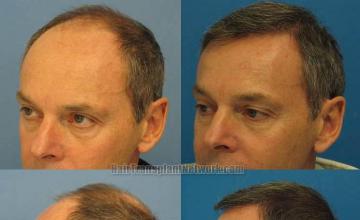 Hair transplantation surgery before and after pictures