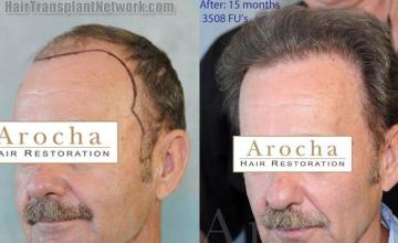 Hair transplantation surgery before and after images