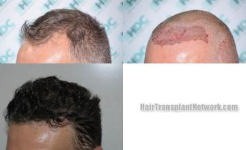 Hair transplantation surgery before and after images