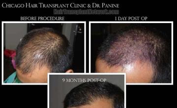 Hair transplantation surgery before and after images