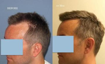 Hair transplantation surgery before and after pictures