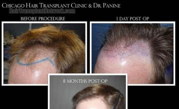 Hair transplantation surgery before and after pictures