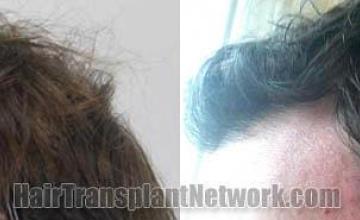 Hair restoration procedure before and after pictures