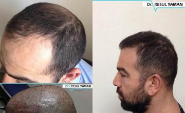 Hair restoration procedure before and after pictures