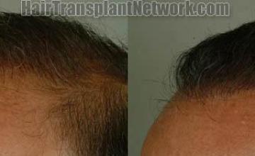 Hair restoration procedure before and after results