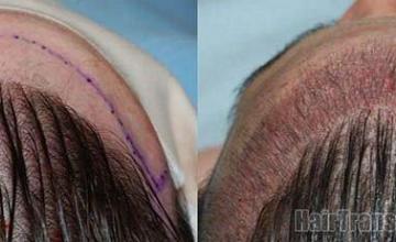 Before and immediate postoperative hair transplant results