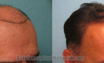 Hair transplantation surgery before and after pictures