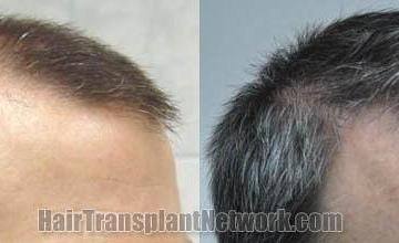 Surgical hair transplantation result photographs