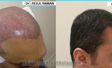 Hair transplantation surgery before and after images