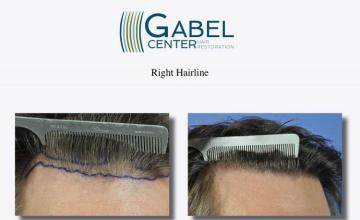 Hair restoration procedure before and after results