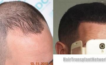 Hair transplantation surgery before and after photos