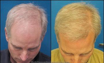 Hair transplantation surgery before and after images