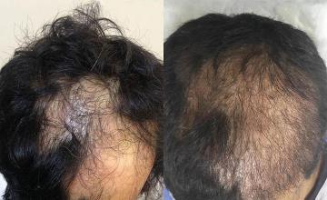 Top view before and after hair restoration results