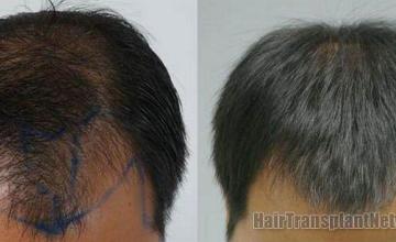 Thai male hair restoration top view