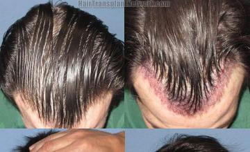 Hair transplant photos viewed from the top