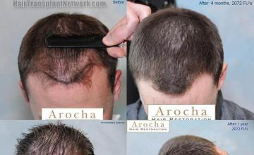 Hair restoration procedure before and after results