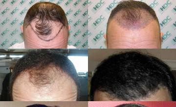 Top view before and after hair restoration results