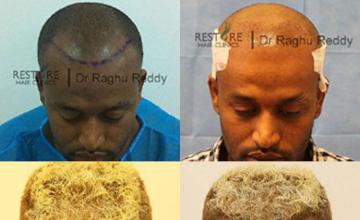 Hair transplantation surgery before and after photos