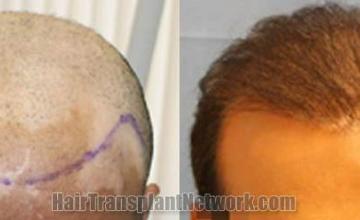 Hair restoration procedure before and after results