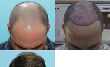 Hair transplantation surgery before and after photos