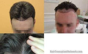 Hair transplantation surgery before and after pictures