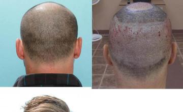 Hair restoration procedure before and after pictures