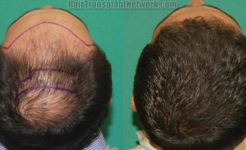 Surgical hair transplantation result photographs