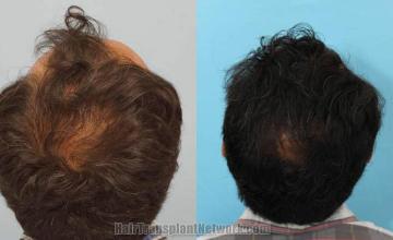 Hair restoration procedure before and after pictures