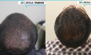 Hair restoration procedure before and after pictures