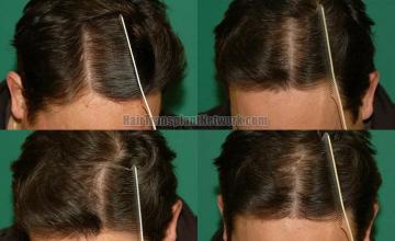 Hair restoration procedure before and after pictures