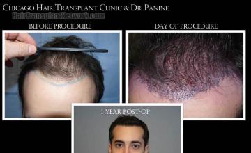 Before and after hair transplant procedure images