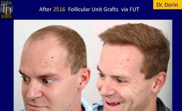 Hair restoration procedure before and after pictures